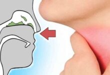 بكتيرية أم فيروسية.. كيف يشير لون المخاط إلى نوع العدوى؟
