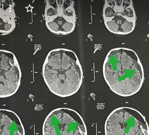 فريق جراحي بمستشفى كفر شكر التخصصي ينقذ حياة طفل 5 شهور يعاني نزيف بالمخ